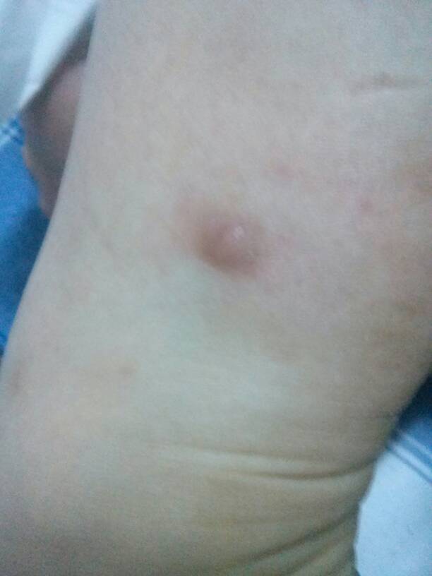 去年腿上长了一个这个硬疙瘩 不痛不痒 就是硬硬的凸起 今年另一个腿