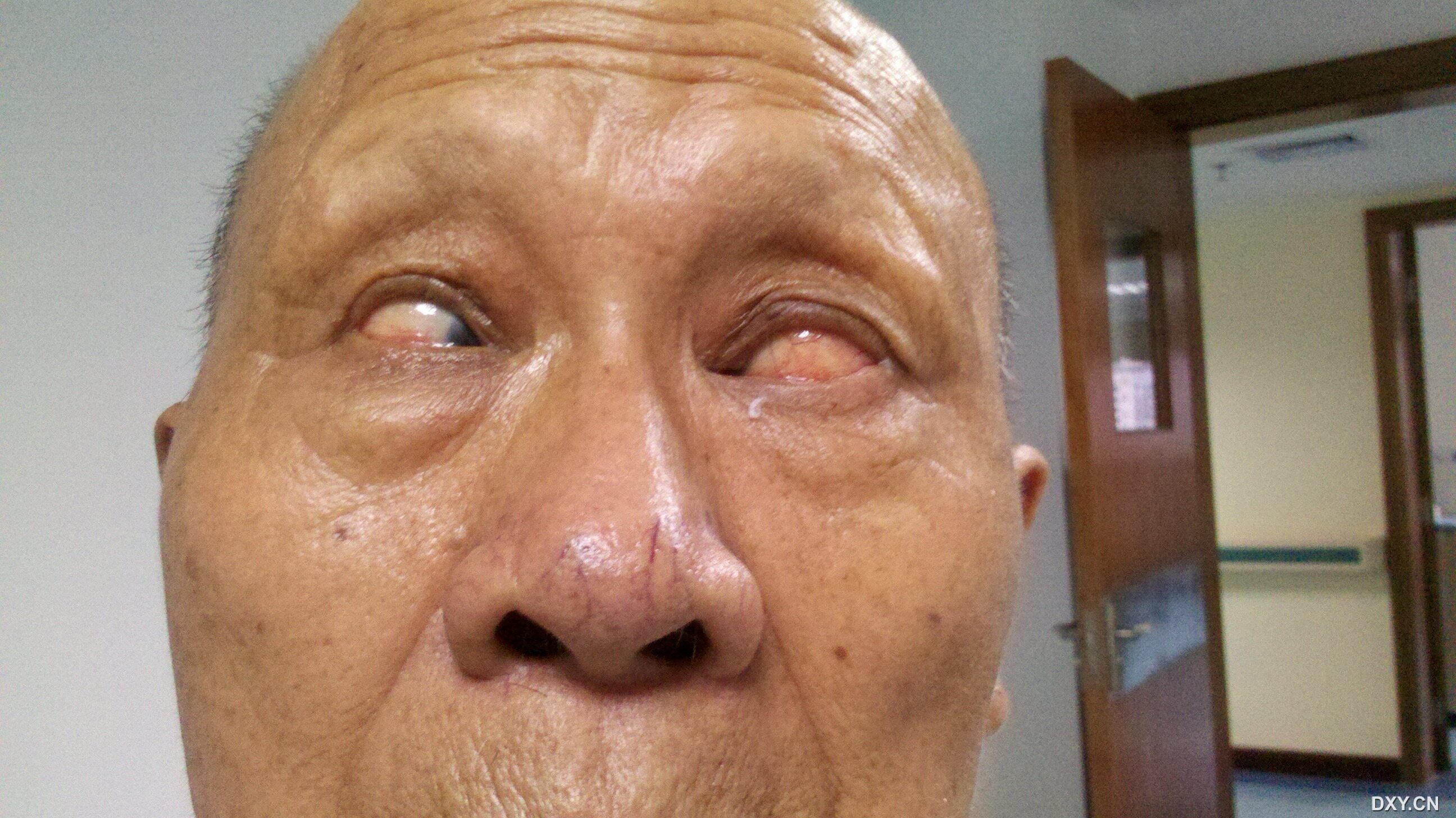 【分享】固定性内斜视