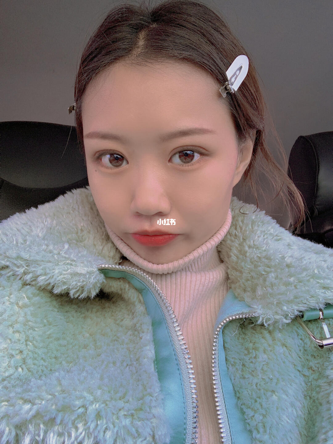 三点定位双眼皮第10天咯～_双眼皮_双眼皮恢复_美妆_医美整形