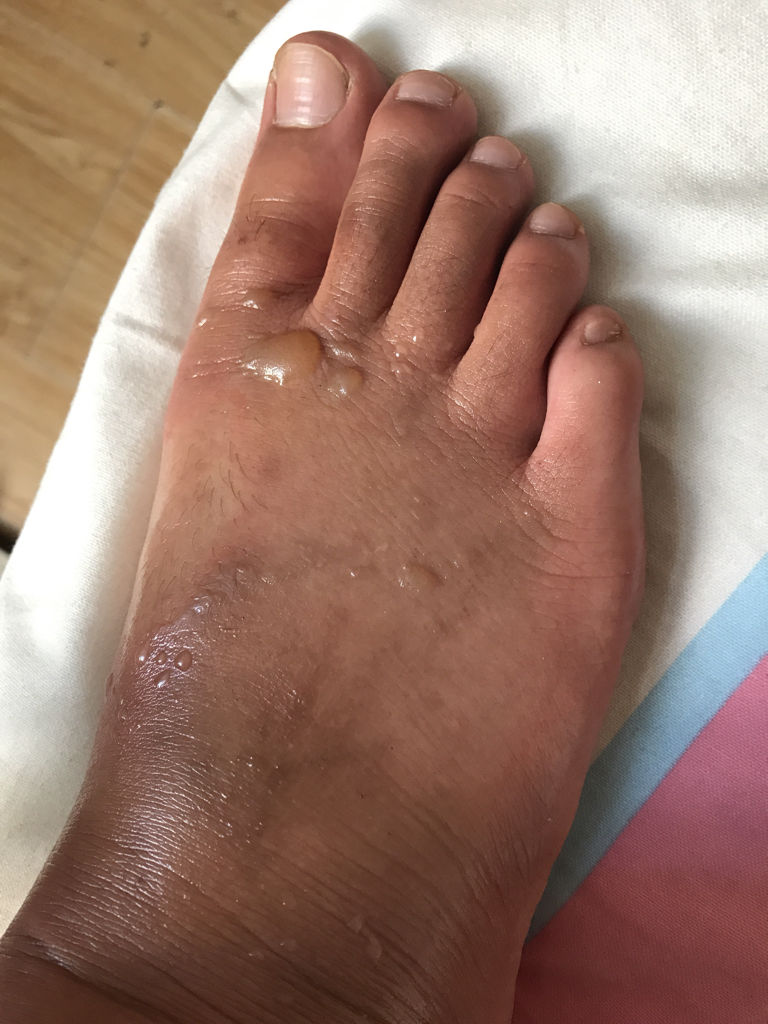 脚背被热水烫伤了 起了5个水泡 ,有什么注意事项么,能碰水么.