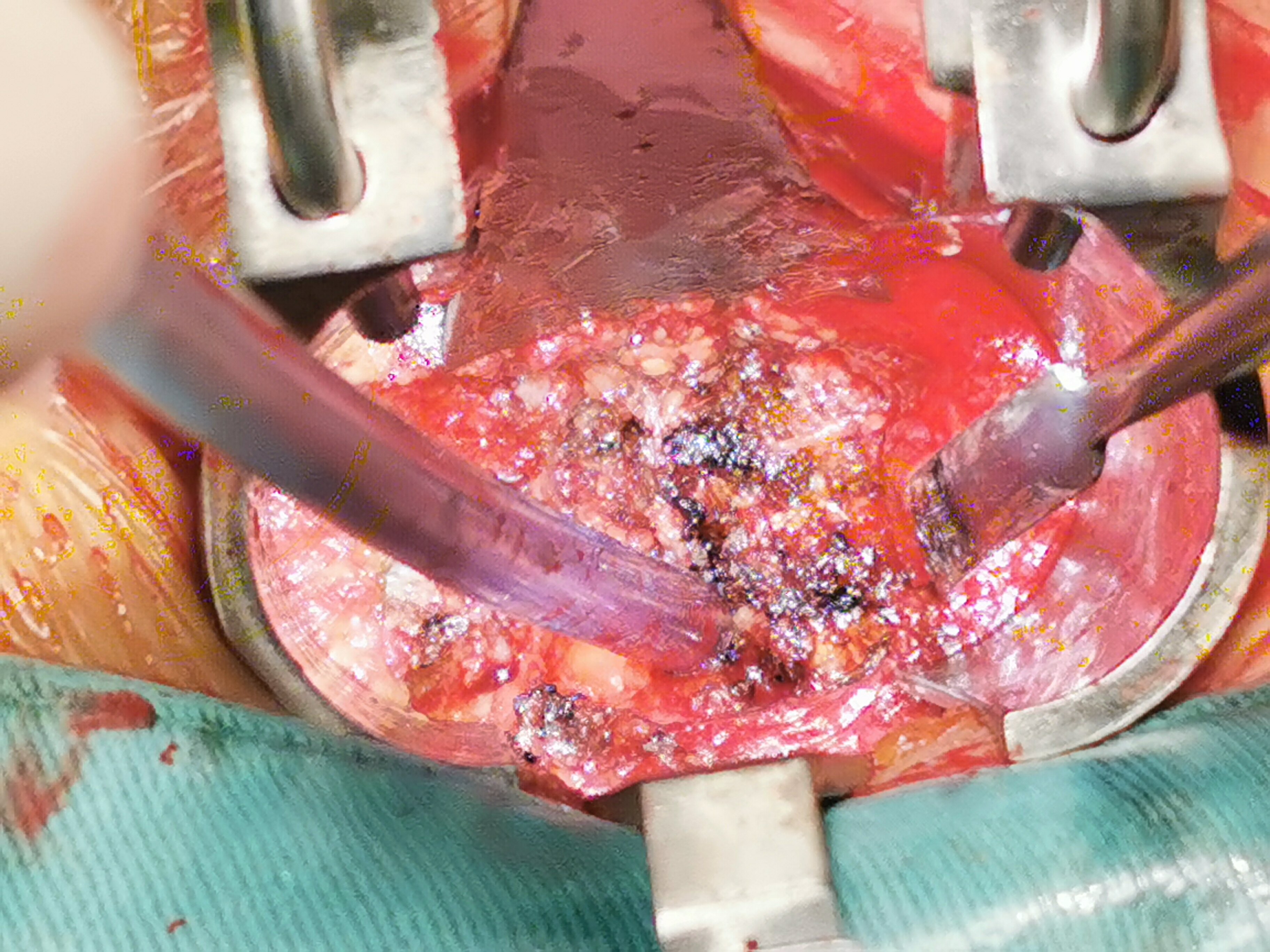 改良的mis-tlif技术:腰椎微创融合经典手术,不额外增加费用的手术.