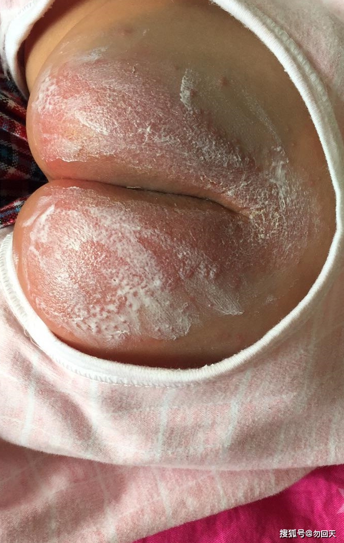 如何治疗尿布疹?如何预防呢_妈妈_宝宝_婴儿
