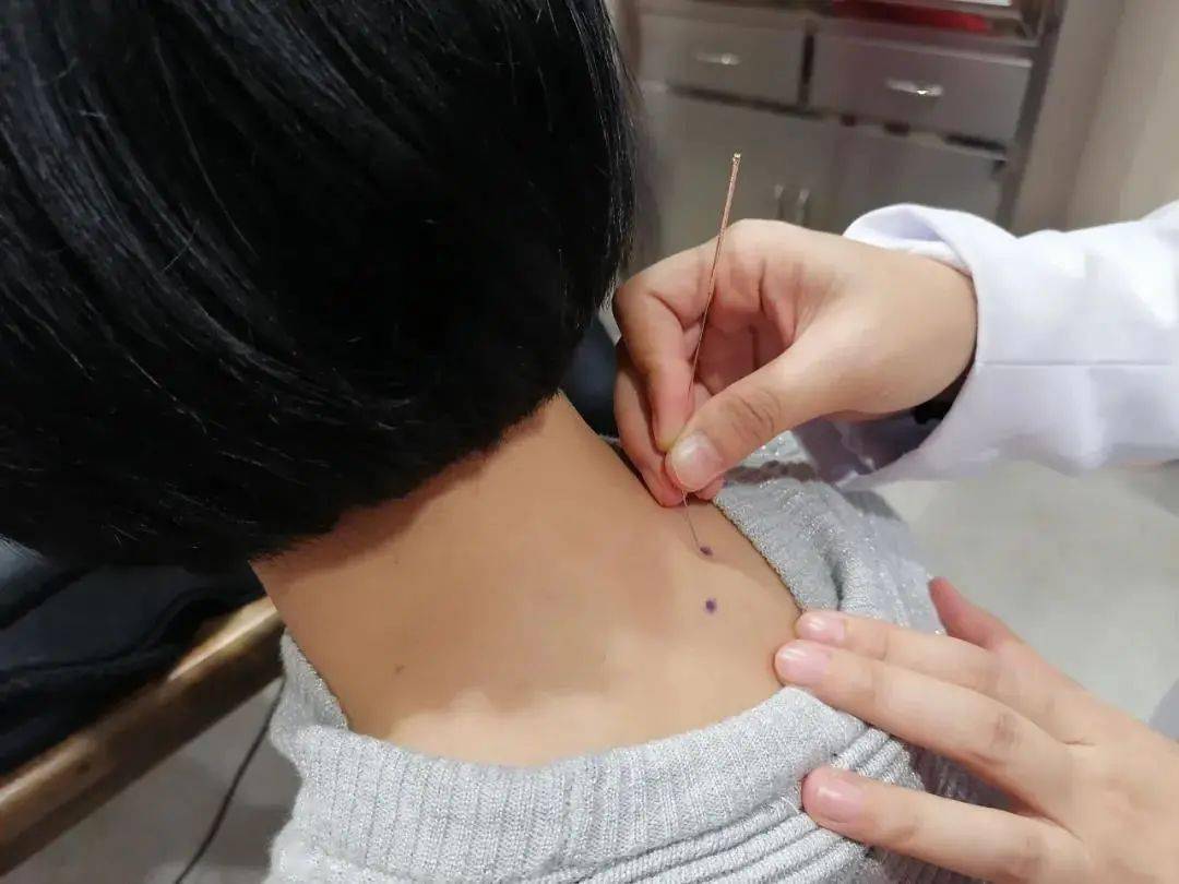 针灸治疗肩周炎特效穴位有奇效