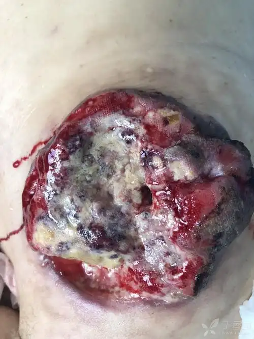 乳腺癌,火山样破溃,过目难忘!