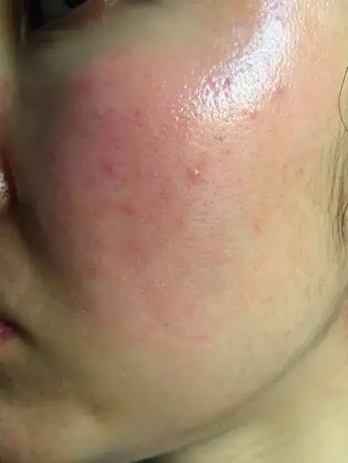 初颜净什么产品可以修复皮肤屏障受损皮肤屏障受损用什么产品修复