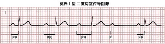 二 度房室传导阻滞 1.