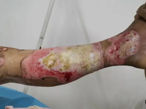 患者左下肢烧伤后1天,又其他医院转入我院