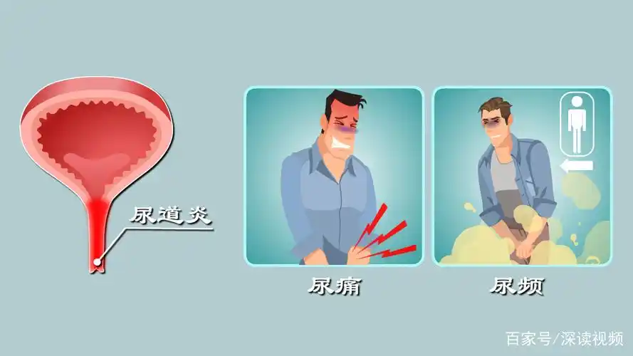 一般尿道炎症状有哪些 一般尿道炎症状有哪些图片
