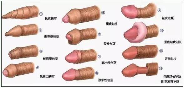 包茎是怎样形成的