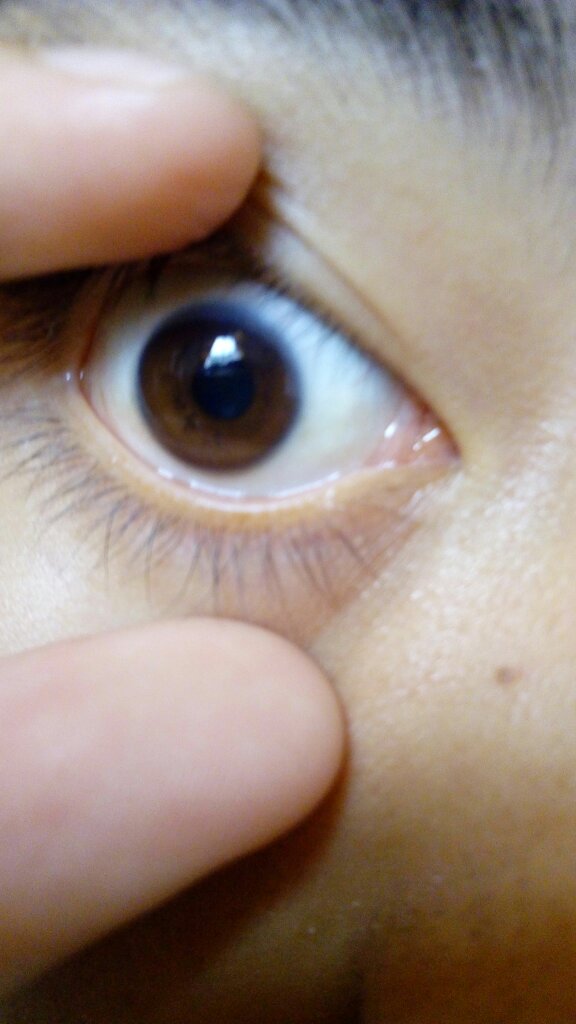 麻烦医生看看我的眼睛正常吗?