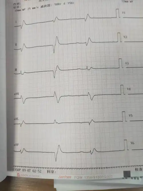 实践版致命心电图的识别与处理之一