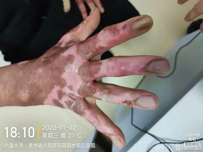 烧伤手部瘢痕挛缩治疗方案探讨中