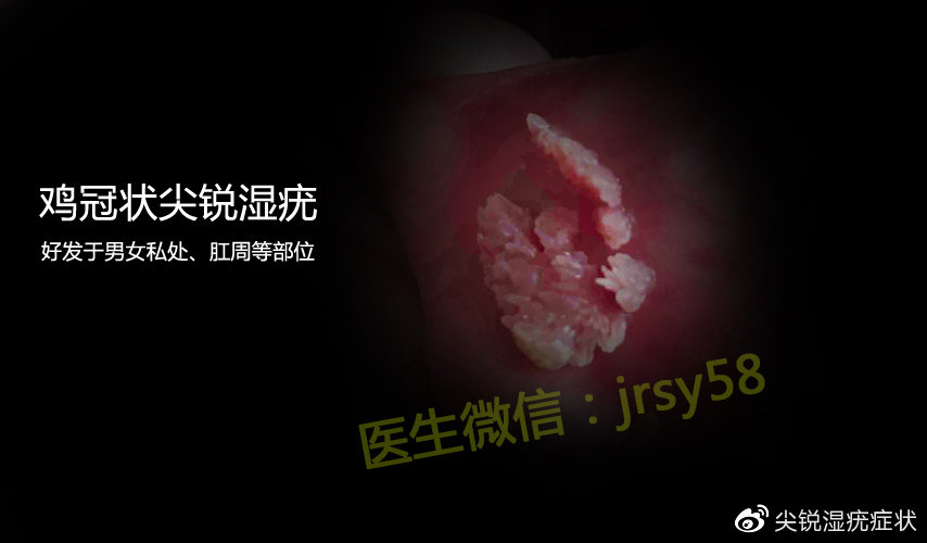尖锐湿疣是什么样子图片大全初期
