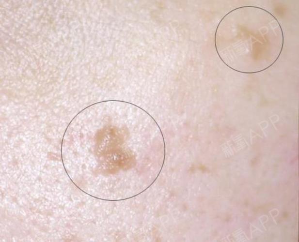 男性假性尖锐湿疣初期图片是怎样的