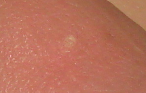 龟头上有一个白色圆环状小圈,直径一毫米,硬质,不痛不痒.时间有2年了.