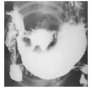 图3-41 胃溃疡型癌,钡餐检查,见腔外不规则龛影,有"环堤"及"指压迹"征