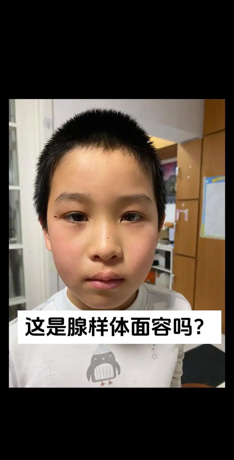 腺样体肥大 #张嘴睡觉 久了就这样了01,坚持这样做,看看 - 抖音