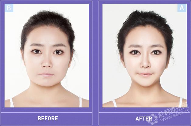 a特整形中心真人整容前后对比图片