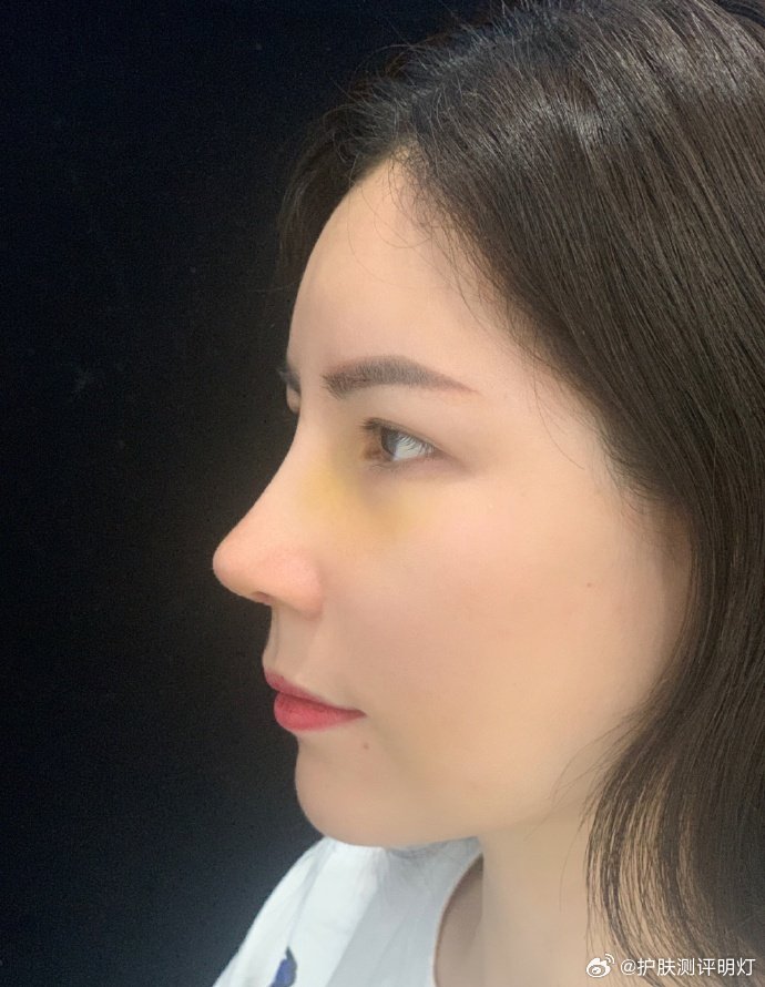 图一和图二是我刚拆完线时的鼻子照片,我觉得这个鼻型非常符合我的