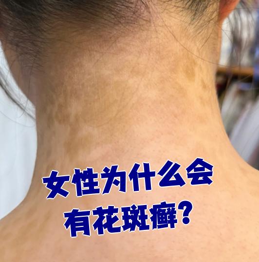 花斑癣是由马拉色菌感染皮肤角质层引起的皮肤病