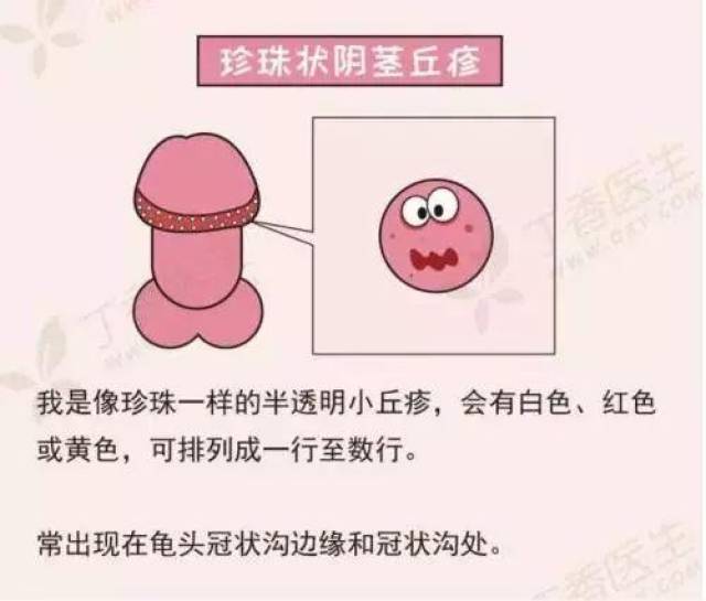 比较容易怀疑的良性病变时阴茎珍珠状丘疹,阴囊湿疹.