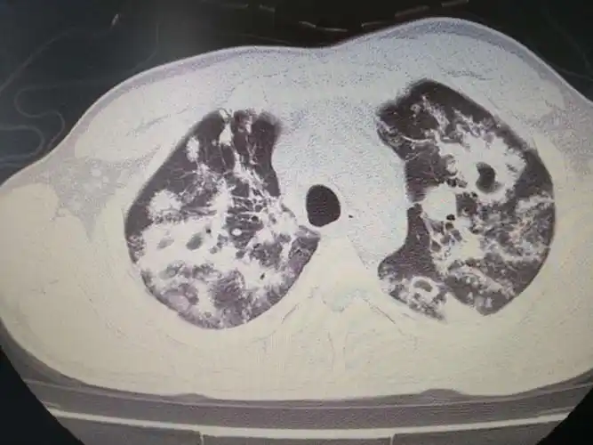 继发性肺结核,32岁,症状逍遥,新书库房工作