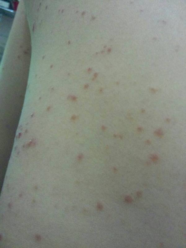 全身起满了这样的红疹,痒得不是很厉害,但