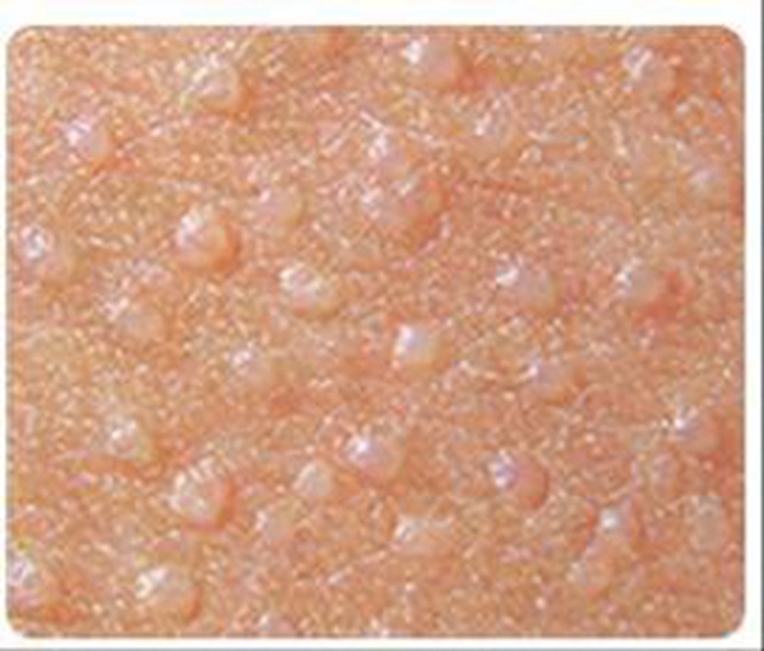 丝状疣的对比图片