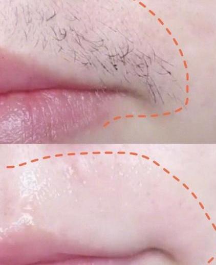 拔掉女生的小胡子很尴尬,该怎么去除唇毛?