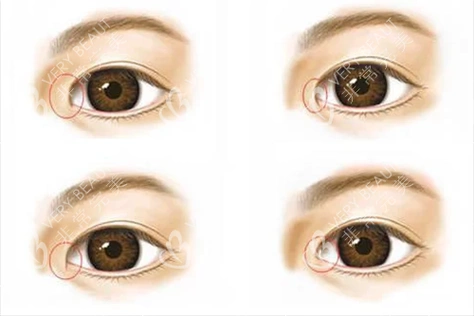 不同程度内眦赘皮示意图