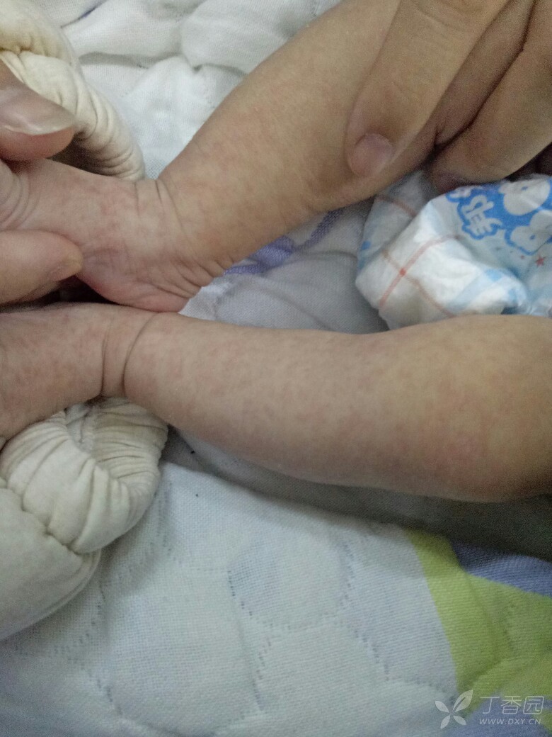 26天新生儿红色样皮疹考虑什么 26天新生儿红色样皮疹考虑什么