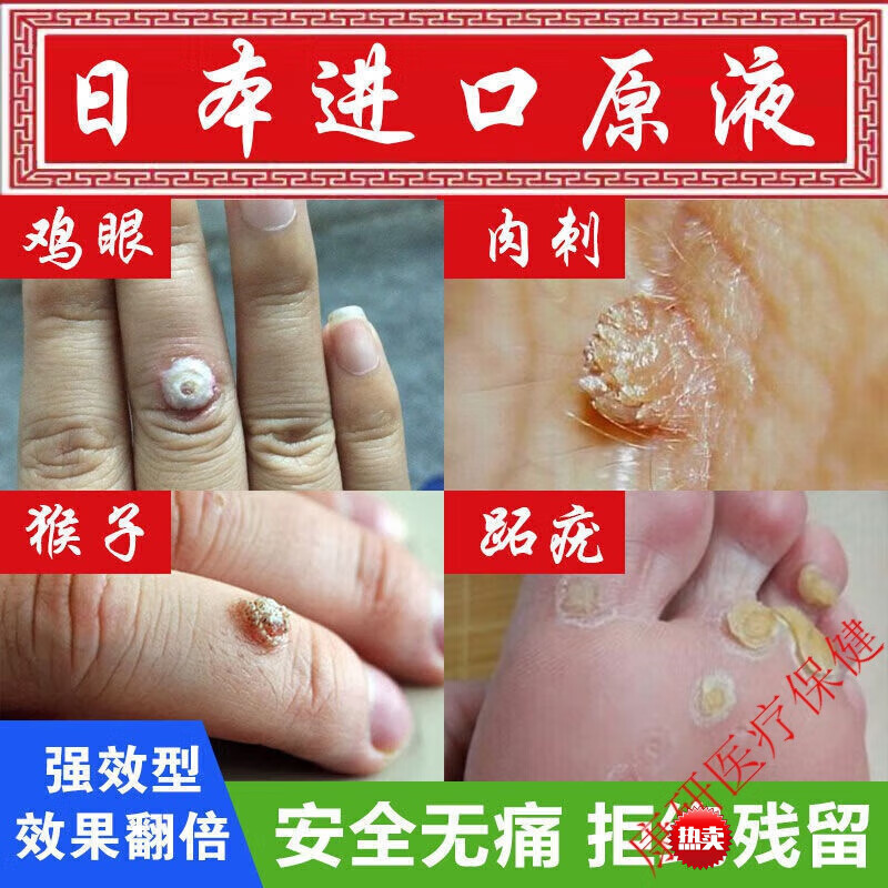 丝状扁平疣颈部去疣候子克优液脖子疣侯灵肉刺肉粒尖锐疣克尤液净疣液