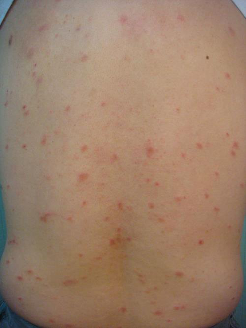 早期梅毒感染症状图图片