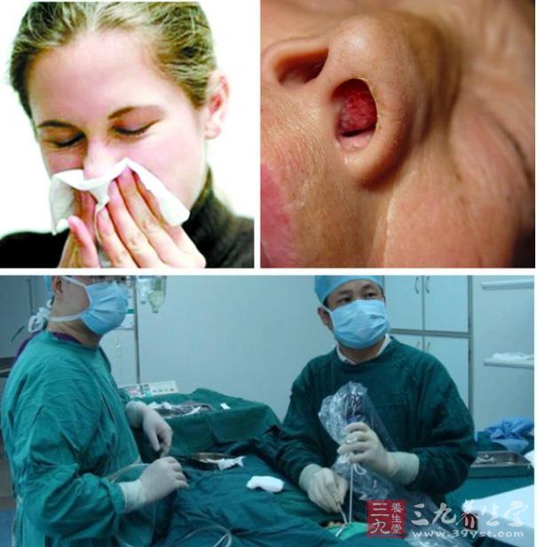 宝宝鼻息肉怎么引起的