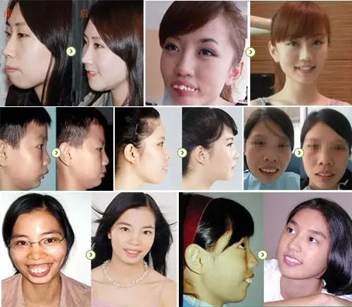 龅牙矫正真实案例 前后对比图