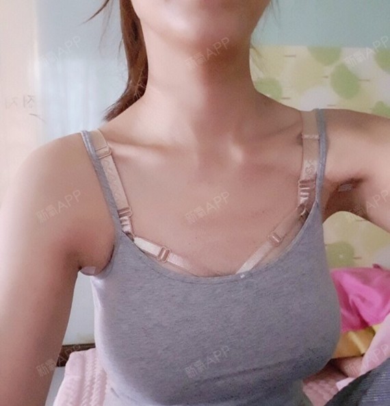 术后7天,突然变这么大胸,好忐忑,但又抑制不住有点小开心呢!