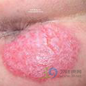 肛周湿疹