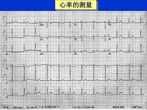 正常心电图教学2007ppt