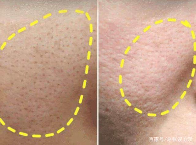 脸上毛孔粗大就像是"橘皮",难看又坑洼,简单3招,告别大毛孔