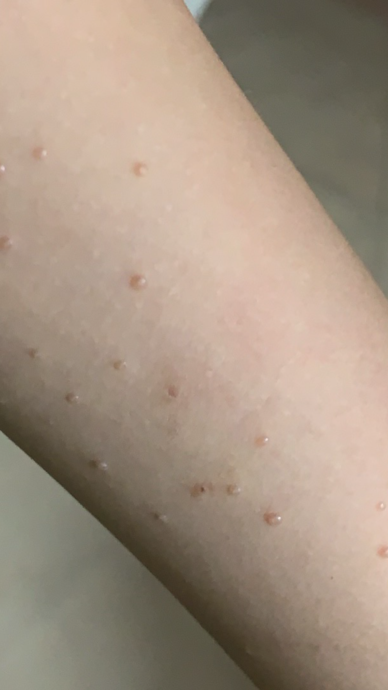 传染性软疣_介绍_治疗方式 - 好大夫在线