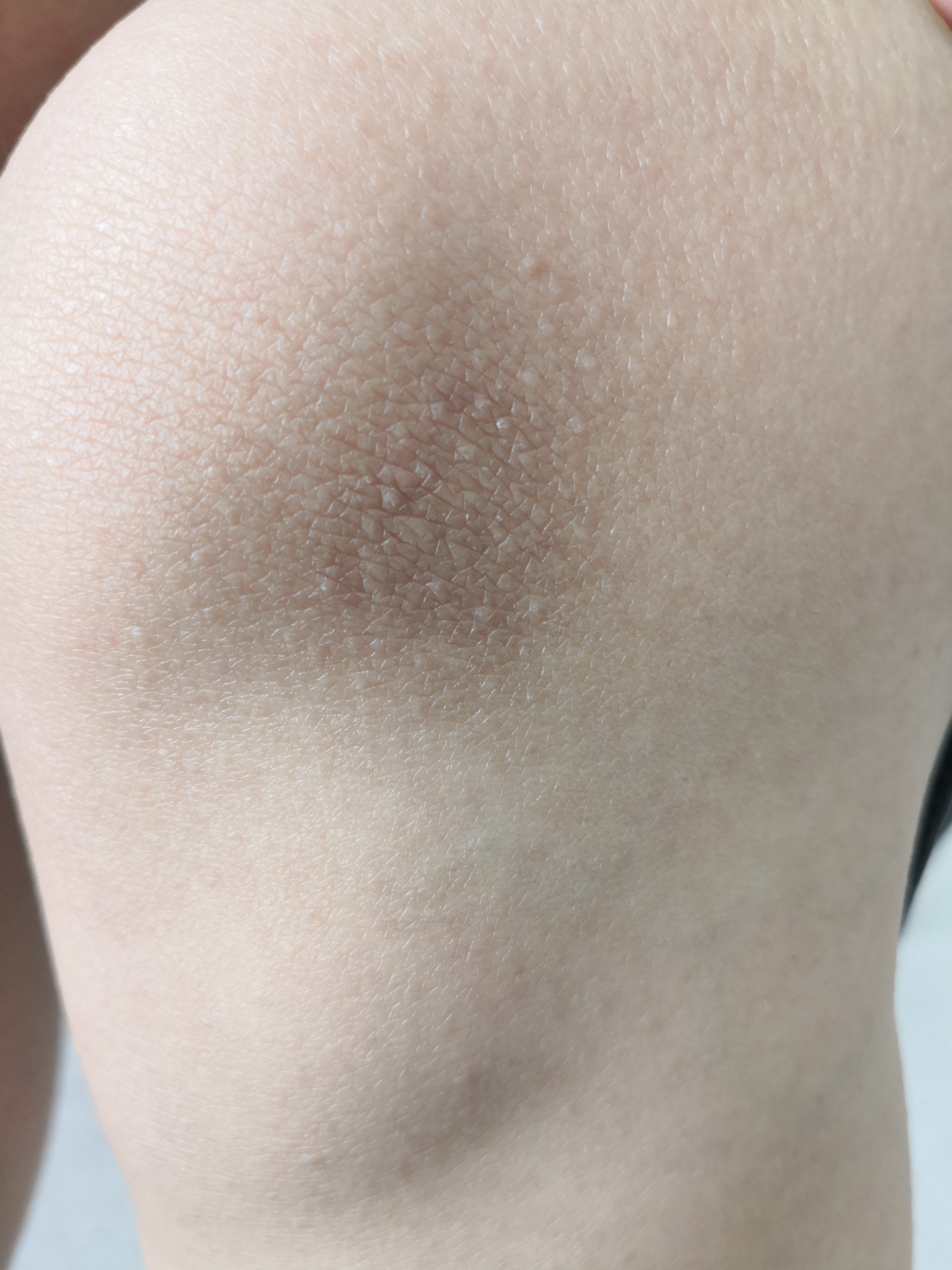 膝关节周围皮肤干燥粗糙 ,苔藓样变斑块.有过敏体质病史和家族史.