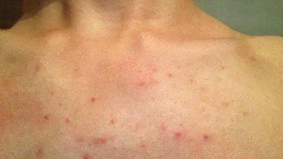 肝癌晚期身上出现红点 - 搜狗图片搜索