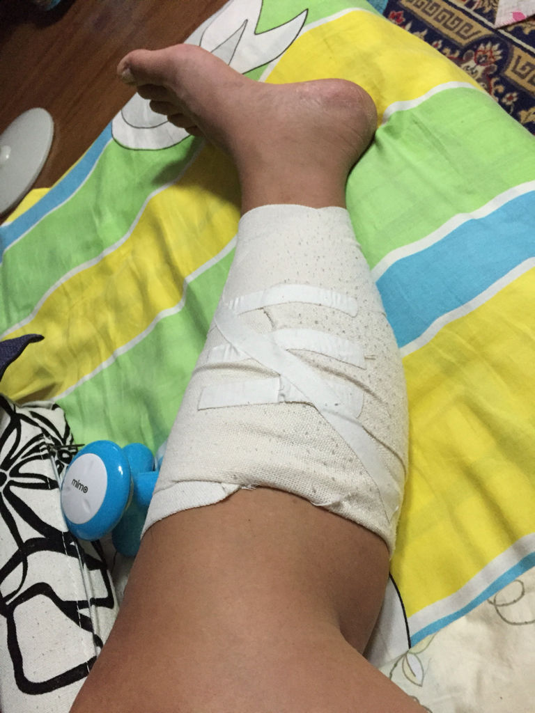 我小腿肚子因打篮球腓肠肌撕裂已经躺了20天了,现在不怎么疼了,可还是