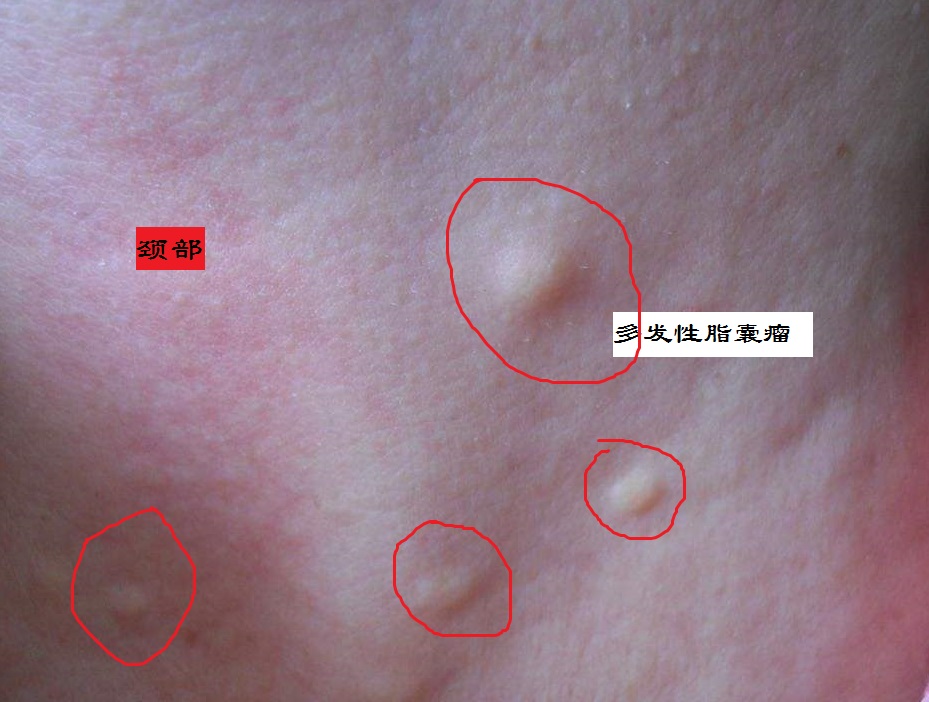 多发性脂囊瘤(咨询)