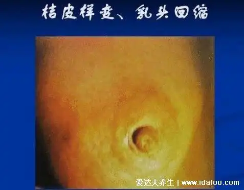 业余!乳腺癌的15个征兆"同样甜蜜"-第1张图片-乐天博客