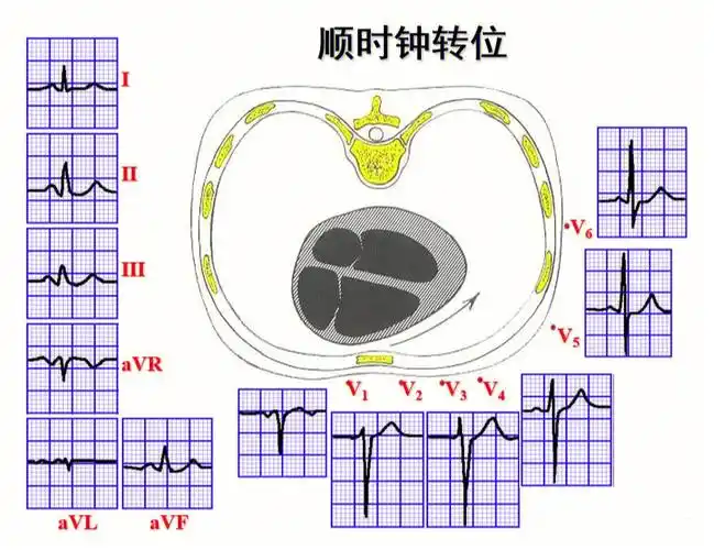 心电图电轴速记