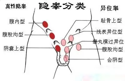 婴儿睾丸隐睾而且还是发育不良!