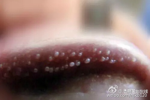 男性珍珠状丘疹和尖锐湿疣不同它与