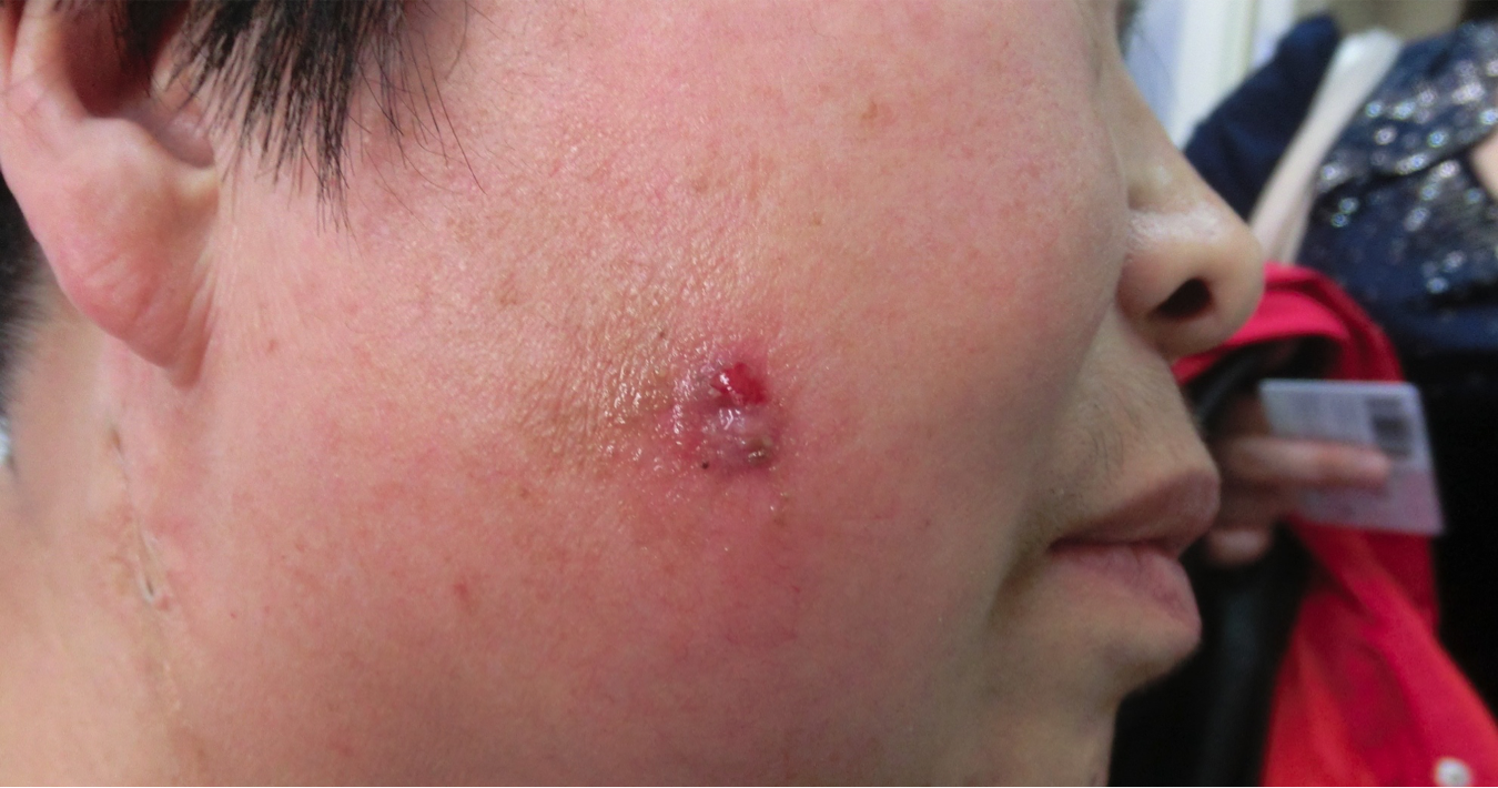 带你认识最常见的皮肤癌——基底细胞癌_基底细胞癌_症状_检查_治疗