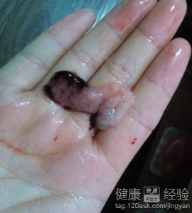42天药流排出孕囊图片 - 搜狗图片搜索